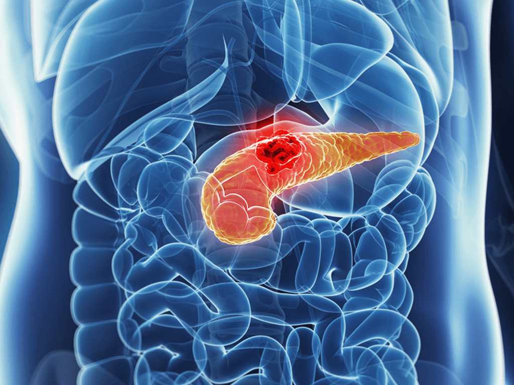 TYME Sponsored Pancreatic Cancer Trial