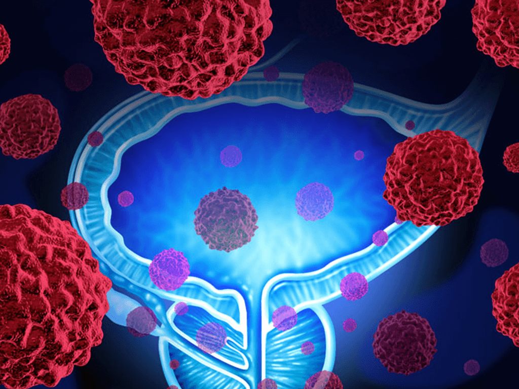 TYME Sponsored Prostate Cancer Trial